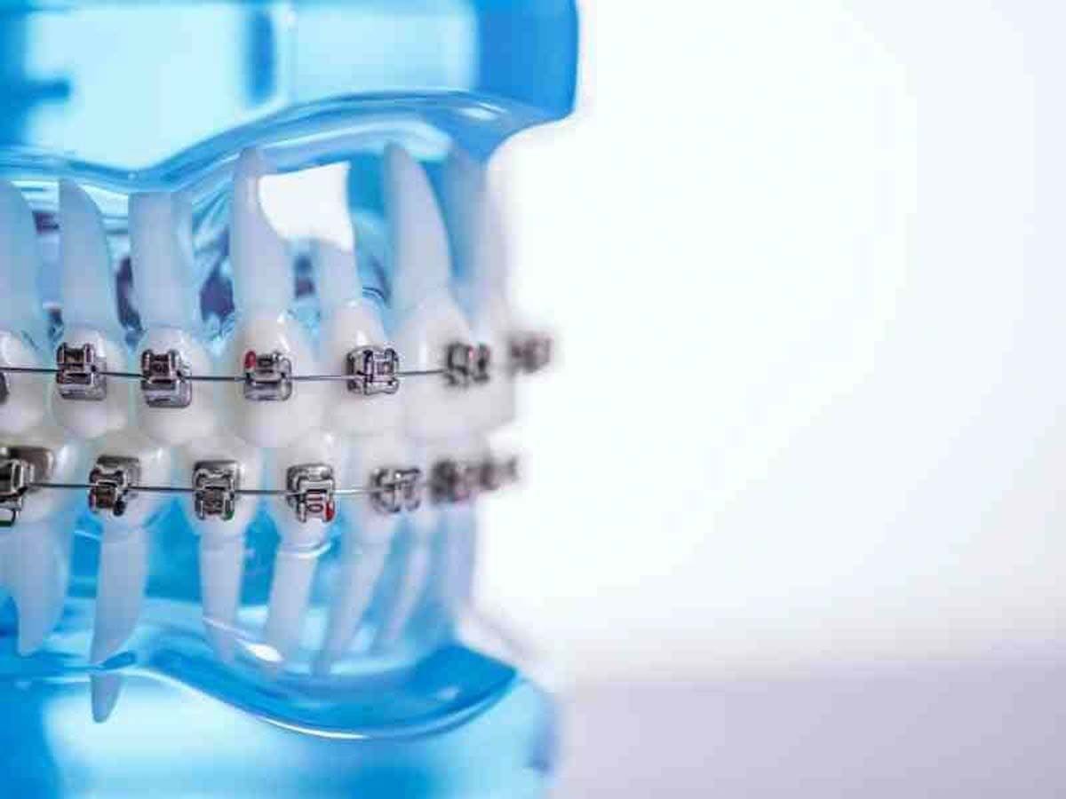 KLOwen Custom Metal SL Solution from KLOwen Orthodontics. Image credit: © KLOwen Orthodontics