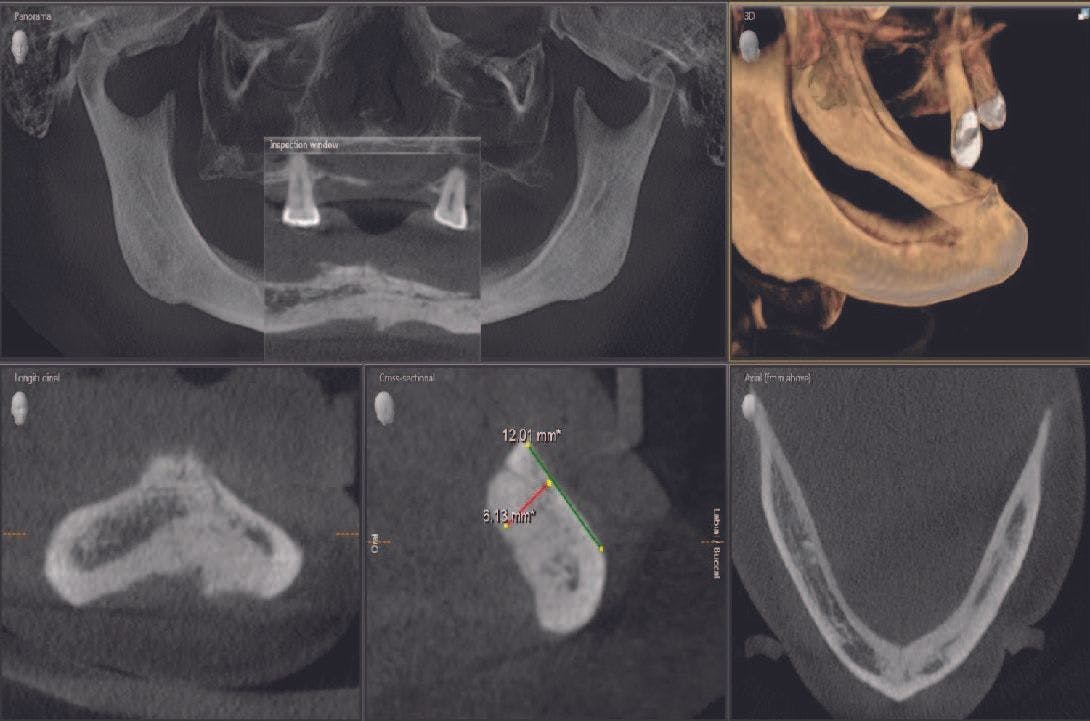 Using One-Piece Implant System to Restore a Severely Atrophic Mandible
